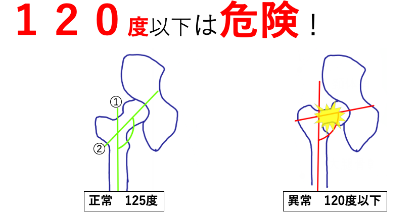 股関節の頚体角